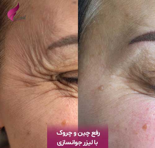 Fix wrinkles with laser rejuvenation