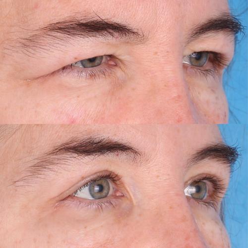 blepharoplasty
